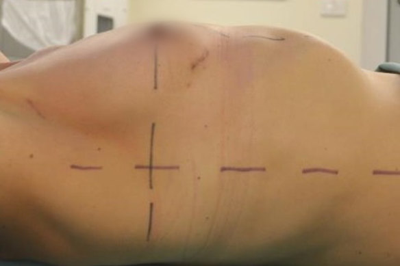 Temporary skin markings on a breast cancer patient.