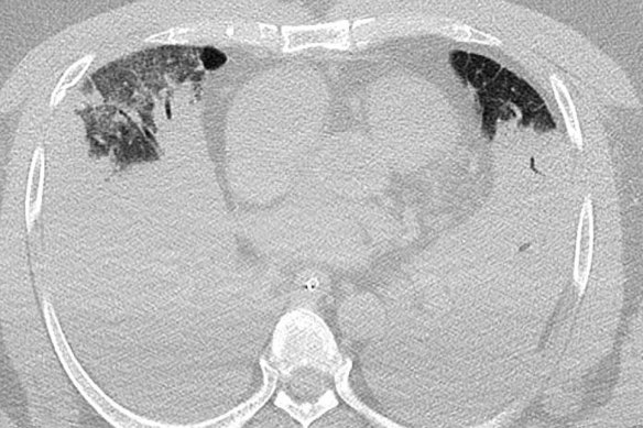 This CT scan from a deceased COVID-positive person shows lungs that are almost airless. The black areas at the top are air.