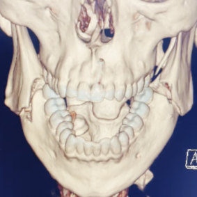 Scans of Jai Opetaia’s jaw, which was broken on both sides.