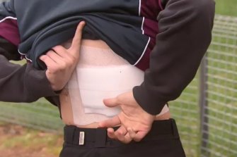 Jack’s wound site.