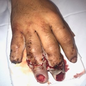 The right hand of a 32-year-old man who underwent microsurgery to reattach his severed fingers after a forklift accident. 