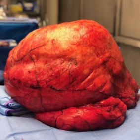 The 34-kilogram tumour was removed after hours of surgery. 