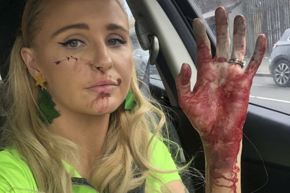 Annie Nolan was bitten by a dog after trying to help separate two animals in Footscray.