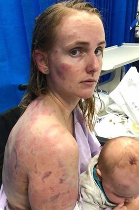 Kingaroy mother Fiona Simpson shielded her daughter as they were hammered by hail.