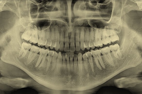 The roots of teeth extend into the upper and lower jawbones, as in this X-ray of adult teeth.