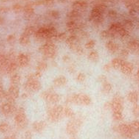 Rashes occur several days after infection, with coughing and sinus symptoms appearing first. 