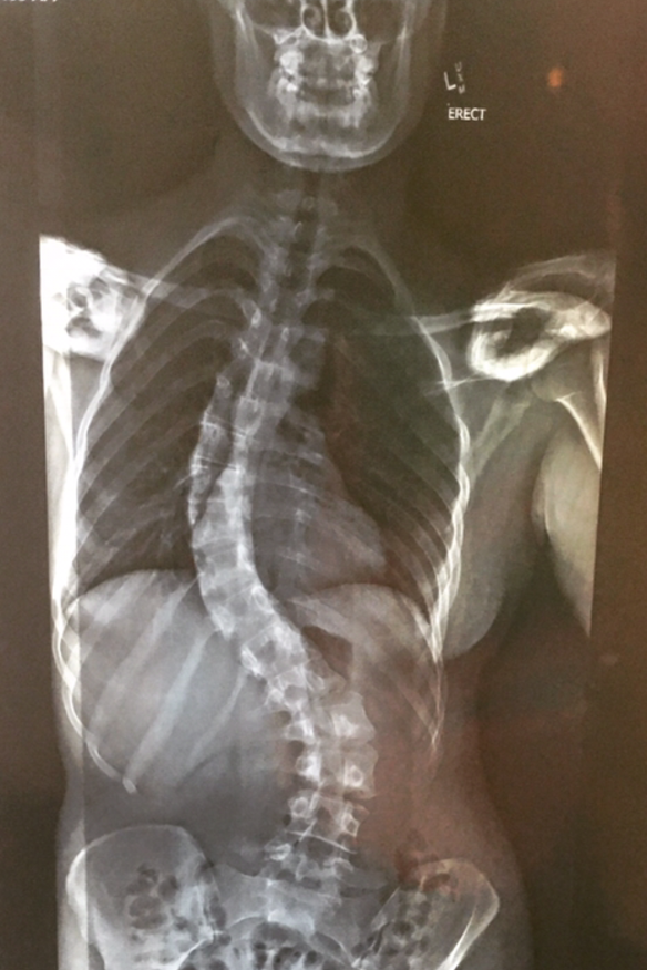 Ashwood's spine, pre-surgery.