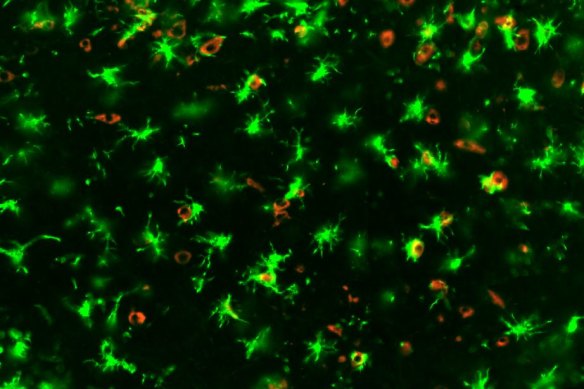 A COVID-19 infected mouse brain showing ‘angry’ microglia in green and SARS-CoV-2 in red.