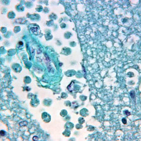 A brain tissue specimen after a naegleria fowleri amoebic infection. 