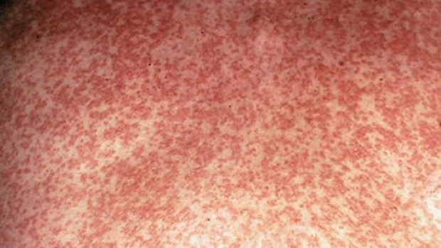 Outbreak: A woman in Sydney has become the 31st case of measles in NSW since Christmas. 