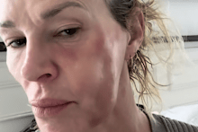 One of Glanville’s diagnoses is a facial mite called Demodex dermatitis.