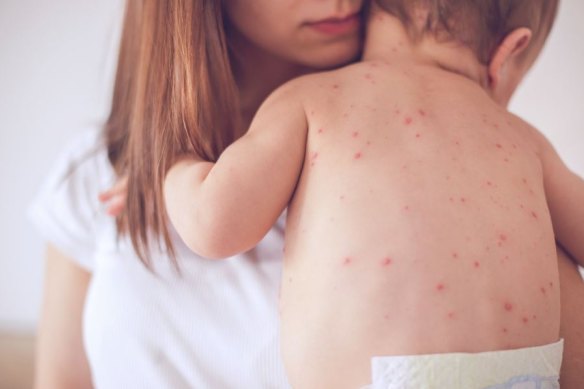 Assumed you were immune to measles and chicken pox? Think again