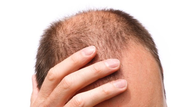 Many miracle cures for hair loss come with a price.