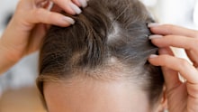 There are many common causes of hair shedding.