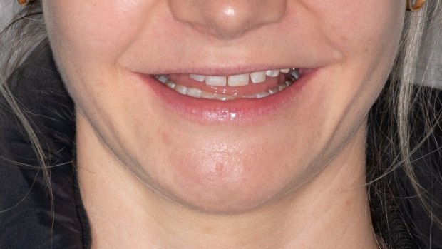 Laura's Gregory's teeth before she got veneers. 