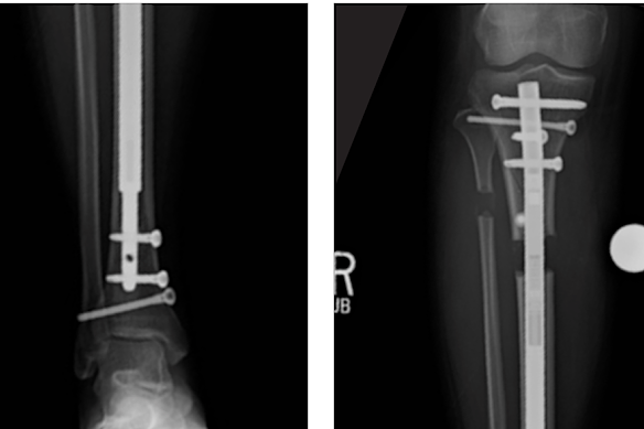 Promotional material depicting the use of the Stryde nail developed by Dror Paley.