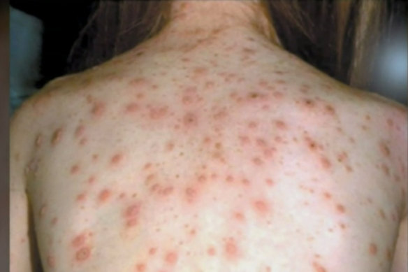 Measles forms a blotchy rash that starts at the neck and head and spreads down.