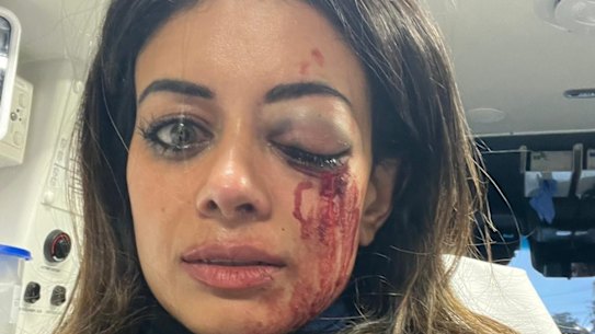 Hannah Thomas with a brusied and swollen eye, and bloodied face in an ambulance after police arrested her during a protest in Belmore on Friday 28 June, 2025. 