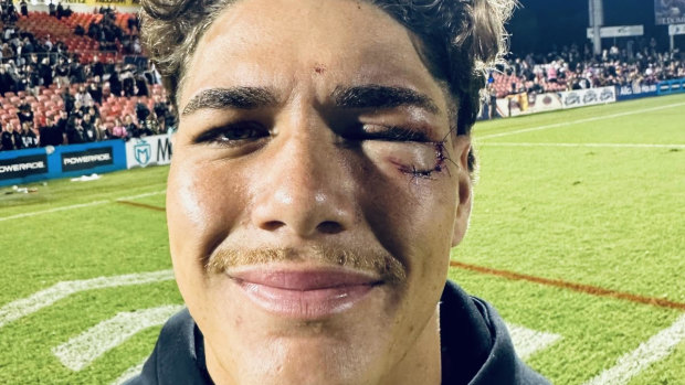 Reece Walsh and his nasty gash after Thursday’s game.