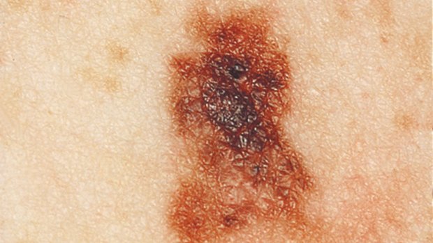 Don't leave it too late to get a potential melanoma checked out.
