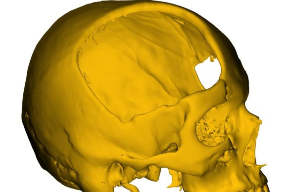 A 3D model of the damage to Brodie's skull which needed to be repaired.