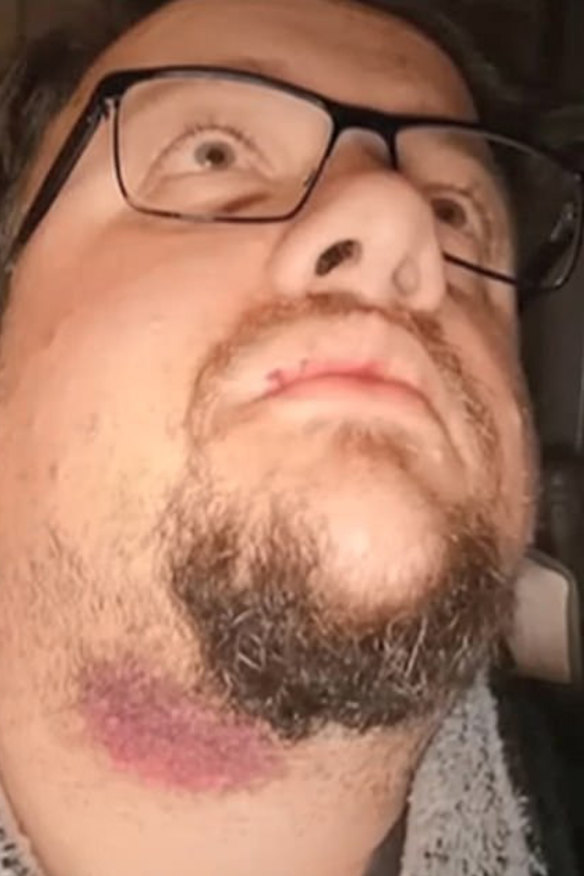 Ryan Naumenko with some of his injuries in 2019.