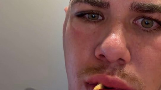 Reece Walsh posted a photo of his fractured cheekbone on Instagram.