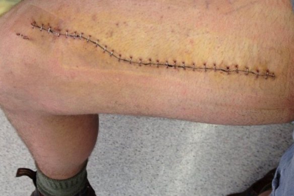 Mr Dingle was speared in the leg by a tree branch in August 2015.