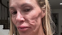 Glanville claimed she saw 21 doctors about her facial disfigurement before she was given the correct diagnosis. 