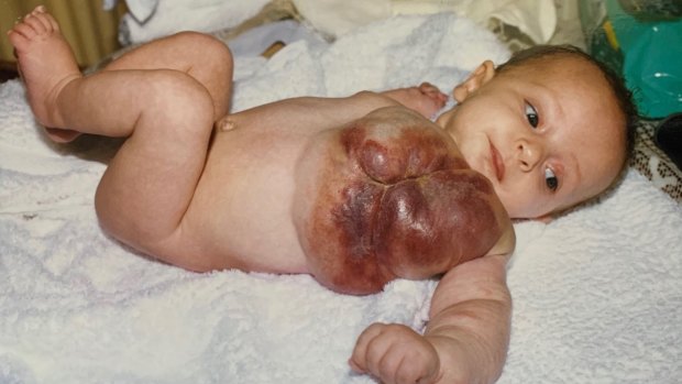 Caitlin had a serious vascular deformity as well as funnel chest when she was born.