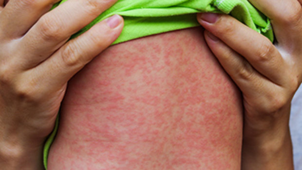 Brisbane's Metro South Public Health Unit has warned of a confirmed measles case.