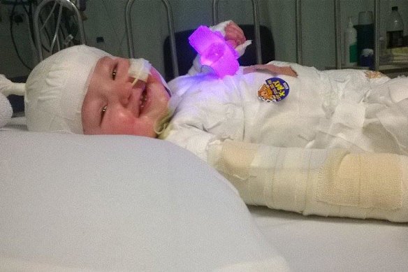 Charlie Burgess was only 11 months old when he suffered burns after pulling a deep fryer off the kitchen bench.
