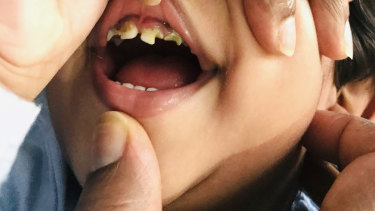 Tharunicaa, who lives in Melbourne Immigration Transit Accommodation with her parents, Priya and Nades and her sister Kopika, has rotting teeth. Picture: Rebekah Holt