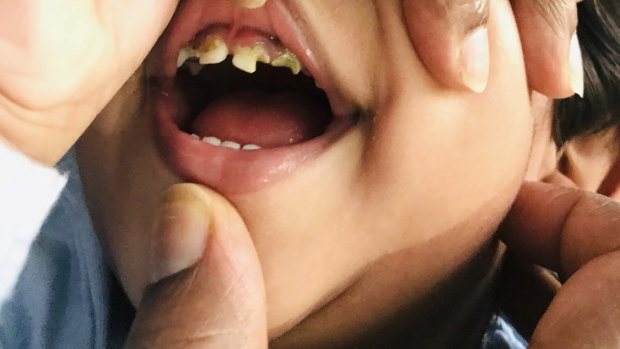 Tharunicaa, who lives in Melbourne Immigration Transit Accommodation with her parents, Priya and Nades and her sister Kopika, has rotting teeth. Picture: Rebekah Holt