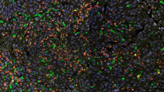 QIMR researchers have found immune cells (stained colours in a melanoma tumour above) can be opposed by a type of cell not previously thought to be involved in tumour response.
