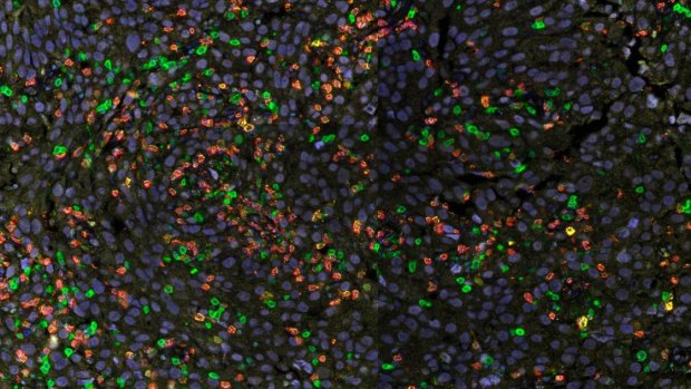 QIMR researchers have found immune cells (stained colours in a melanoma tumour above) can be opposed by a type of cell not previously thought to be involved in tumour response.