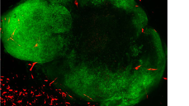 An image showing GBM (Glioblastoma multiforme) tumour cells (red) in a healthy brain organoid (green).