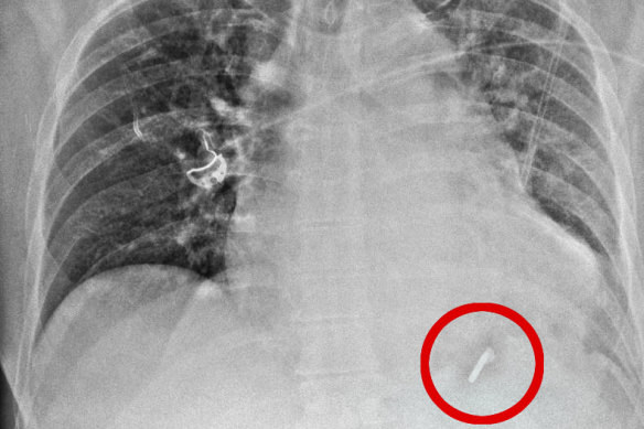 Close call: the nail is circled in this X-ray taken at The Alfred hospital.