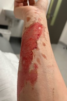 Elena Sabbatini’s burns after a workplace accident.
