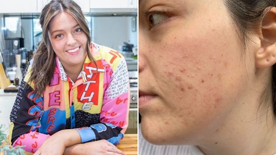 Taylah Simpson dealt with pandemic-related skin flare-ups.