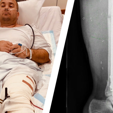 Bill Springett-Kelly in St Vincent's Hospital and an X-ray of his heavily swollen left leg, complete with titanium rods and screws, after the collision.