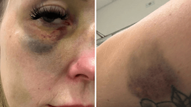 Wright was left with black eyes and a broken nose and says she struggles to breathe properly now.