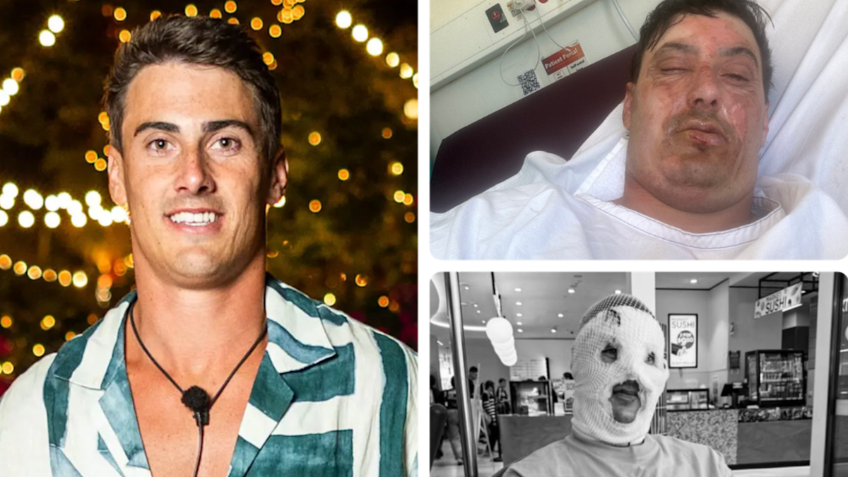 Love Island’s Trent Woolman details freak bonfire accident as he undergoes more surgery