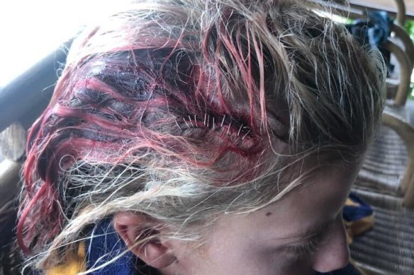 Canadian surf prodigy Erin Brooks’ 15 staples from a fin to the head in the Mentawais in 2020.