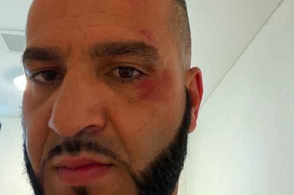 Detainee Joseph Hanna after use of force by six Serco guards.