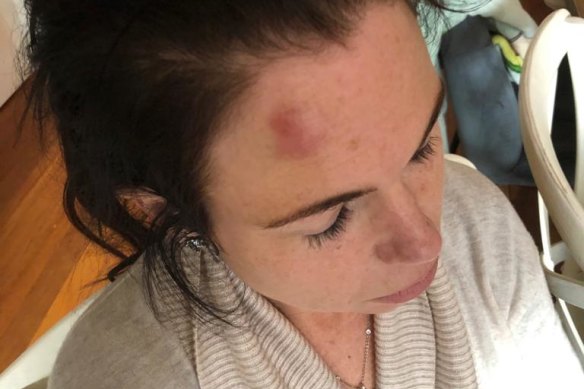 An image of the bruise to Emma Walters’ head after the alleged assault.