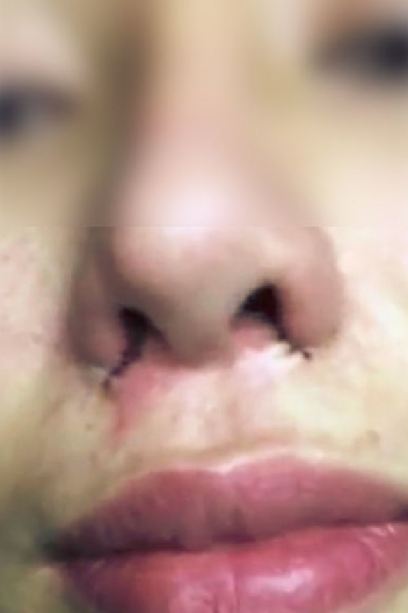 Another cosmetic procedure from Lee Kim Tan's Facebook page.  