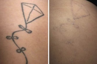 Everything You Need To Know Before Having A Tattoo Removed
