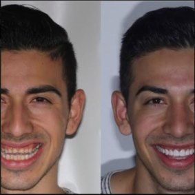 Jono achieved a celebrity smile thanks to porcelain veneers and invisalign.