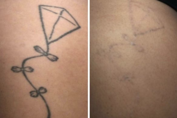 Everything you need to know before having a tattoo removed